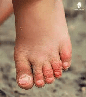 Fungal Infection in Children Fit Due to Poor Fitting Shoes