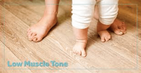 Low-tone Foot In A Baby