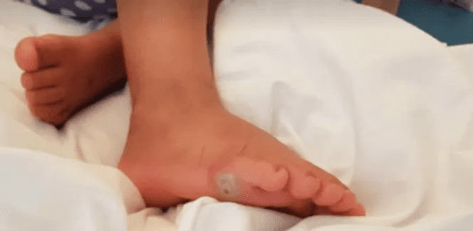 Photo showing blister on child foot due to tight shoe box